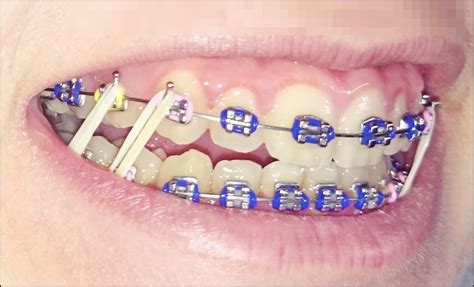 para que sirven las ligaduras metalicas en los brackets|como poner gomas en los brackets.